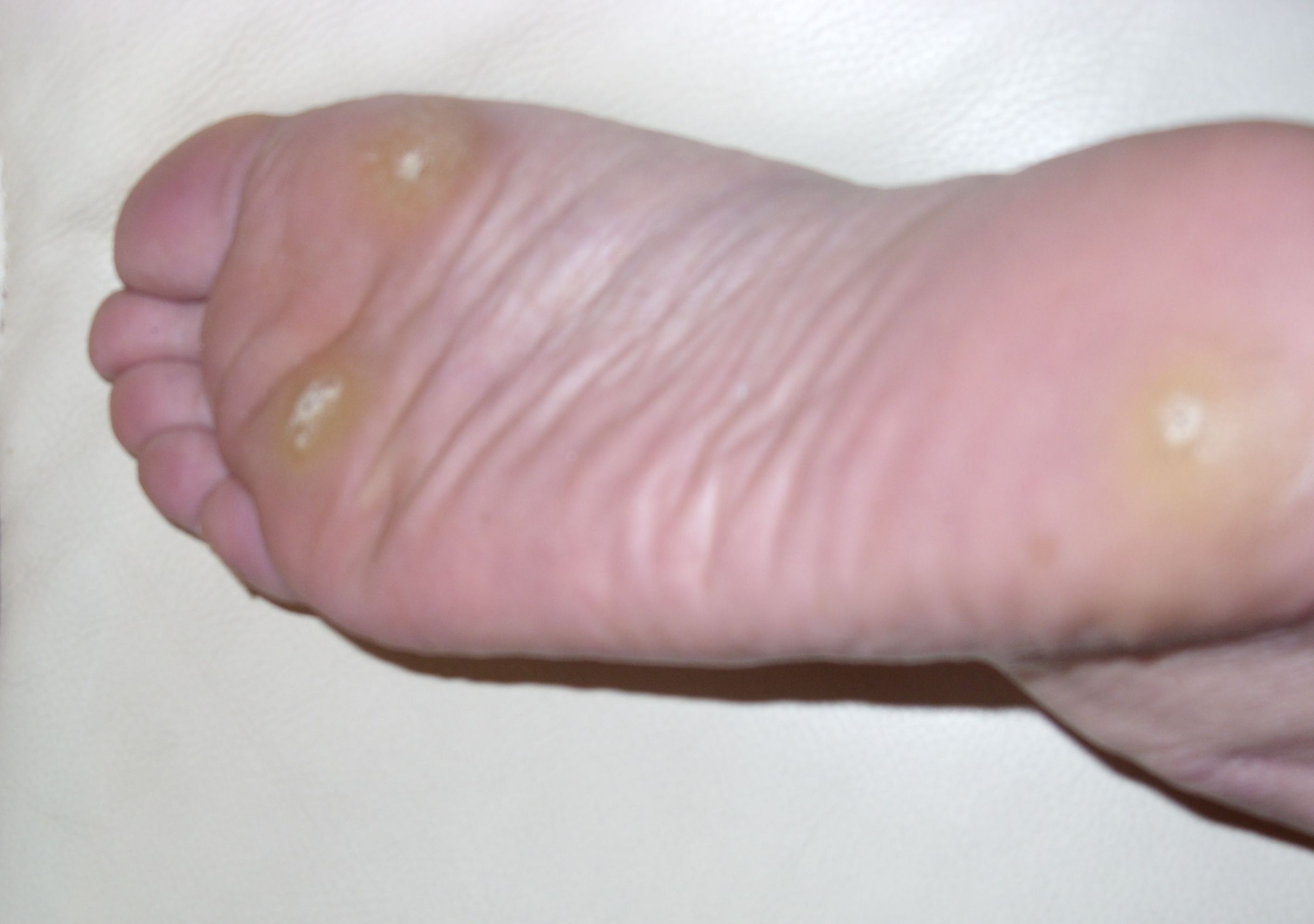 Wartrol on foot