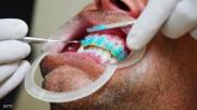 teeth whitening 